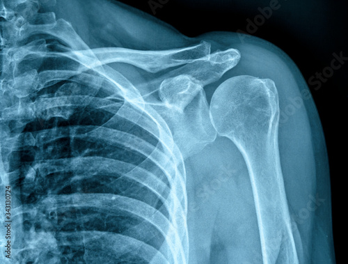 Photo of x-ray human shoulder