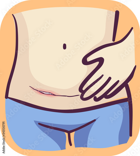 Symptom Pus Discharge Cesarean Wound Illustration