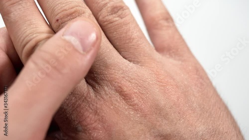 Man's hands with dry skin and fragments of cracked epidermis that exfoliate due to excessive use of alcohol-based disinfectant solutions, reduced sun exposure, lack of Vitamin D. Dermatitis disease.