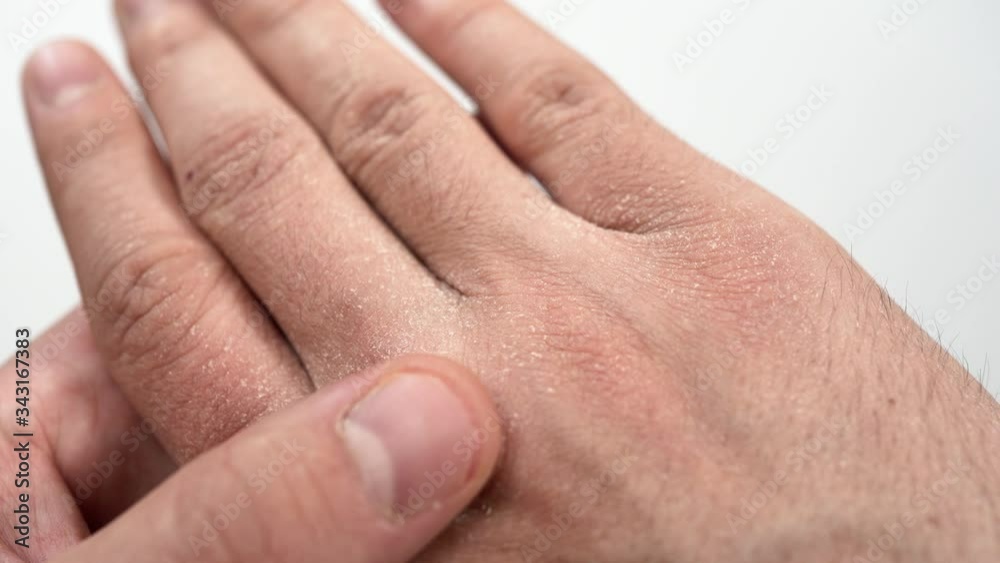 Close-up of a Caucasian man's hand with severely dry and cracked skin after using alcohol-based disinfectant solutions during the coronavirus (Covid-19, SARS-CoV-2) pandemic. Skin rashes, dermatitis. Close-up of a Caucasian man's hand with severely dry and cracked skin after using alcohol-based disinfectant solutions during the coronavirus (Covid-19, SARS-CoV-2) pandemic. Skin rashes, dermatitis.
