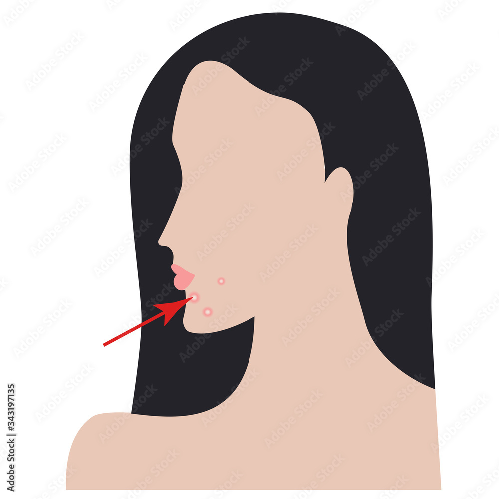 Female face with acne - vector. Health care. The procedure is medical. Beauty salon. Female face with acne - vector. Health care. The procedure is medical. Beauty salon.