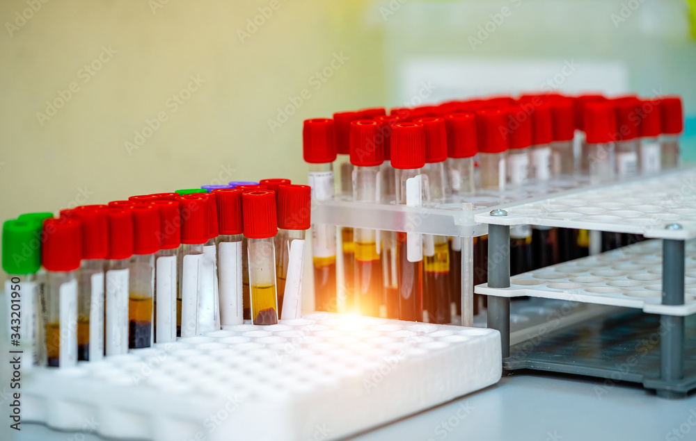 Rack of blood tubes test for analysis in the laboratory of hematology. Blood laboratory. Illness testing. Emergency testing. Virus infection. Rack of blood tubes test for analysis in the laboratory of hematology. Blood laboratory. Illness testing. Emergency testing. Virus infection.