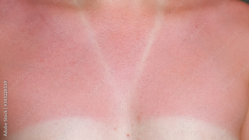 young woman sunburned bare chest and neck with red suntan around white designed swimsuit imprint close-up