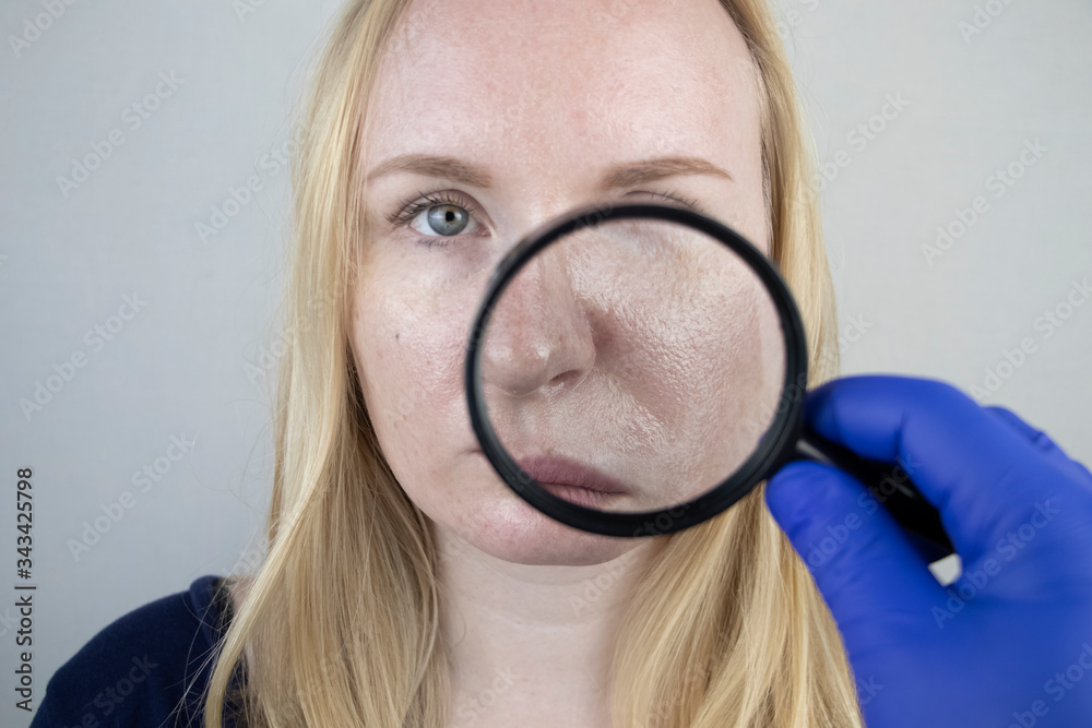 Oily and problem skin. Portrait of a blonde girl with acne, oily skin and pigmentation Oily and problem skin. Portrait of a blonde girl with acne, oily skin and pigmentation