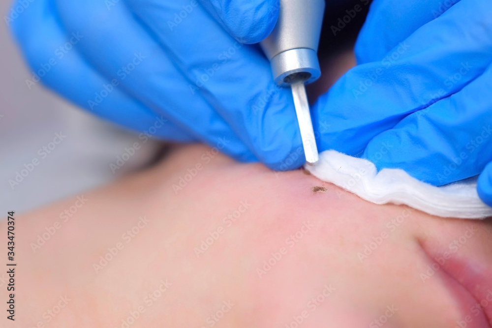 Process of removing mole using laser on woman's face by surgeon, burning skin, closeup view. Cosmetic treatment in beauty clinic. One day surgery concept. Removing birthmark surgical procedure. Process of removing mole using laser on woman's face by surgeon, burning skin, closeup view. Cosmetic treatment in beauty clinic. One day surgery concept. Removing birthmark surgical procedure.