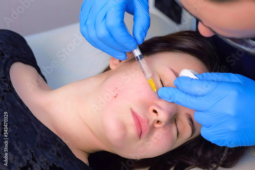 Doctor surgeon is making anesthesia injection on woman s face before laser removal  face closeup. cosmetic treatment in beauty clinic. One day surgery concept. Removing birthmark surgical procedure.