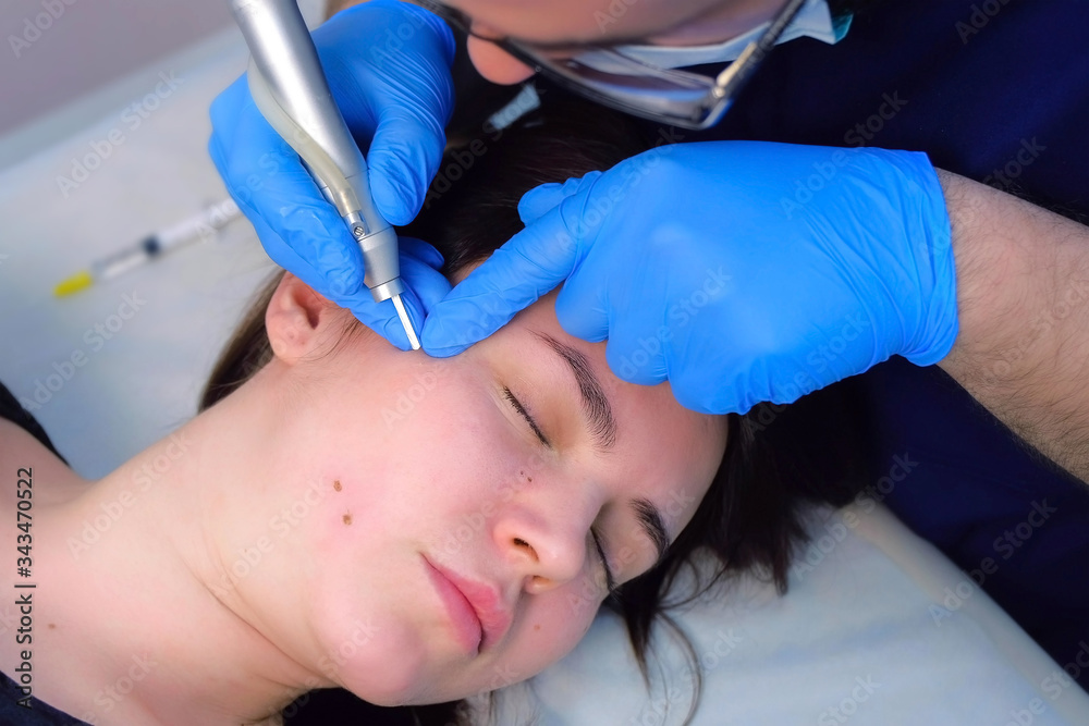 Surgeon removing mole using laser on woman face, burning skin, beauty treatment, closeup view. Cosmetic treatment in beauty clinic. One day surgery concept. Removing birthmark surgical procedure. Surgeon removing mole using laser on woman face, burning skin, beauty treatment, closeup view. Cosmetic treatment in beauty clinic. One day surgery concept. Removing birthmark surgical procedure.