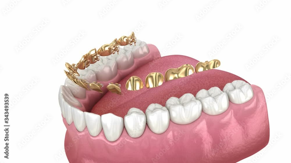Lingual golden braces system. 3D animation concept of golden braces Lingual golden braces system. 3D animation concept of golden braces