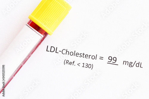 Blood sample tube with LDL-cholesterol test result photo