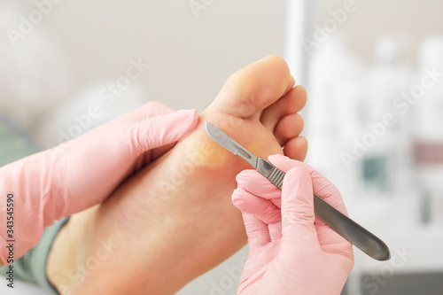 Medical pedicure procedure using special instrument with blade knife holder.Professional pedicure using dieffenbach scalpel.Patient visiting podiatrist.Foot treatment in SPA salon.Podiatry clinic.