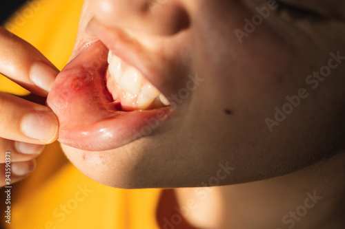 Close up woman with aphtha on lip photo