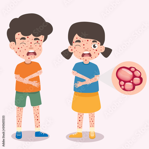Children has chicken pox infographic, Poster children fever and chickenpox symptoms and prevention. Health care and medical  cartoon character vector illustration. Virus and bacteria sign elements.