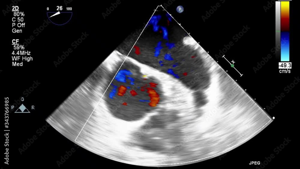Transesophageal ultrasound video in Doppler mode.