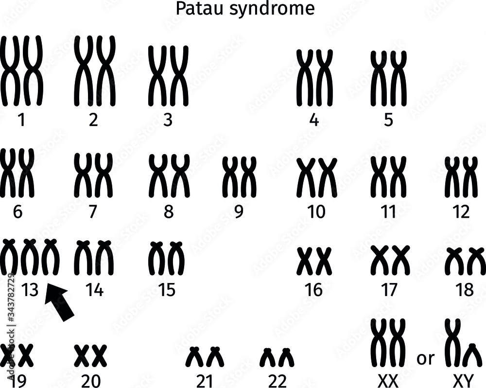 Scheme of Patau syndrome karyotype of human somatic cell 47XX+13 and ...