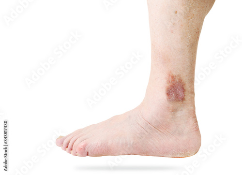 Atopic dermatitis (AD), also known as atopic eczema, is a type of inflammation of the skin (dermatitis) at foot. © lial88