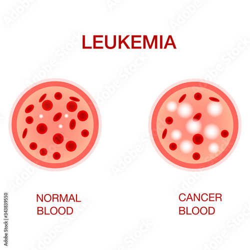 Infographic image of leukemia. Leukaemia disease awareness.Leukemia Blood Cells And Normal Blood Cells White Blood Cells Monocyte . Realistic vector picture .Medical and healthcare concept