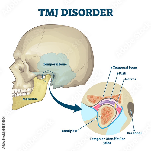 TMJ disorder vector illustration. Labeled jaw condition educational scheme. photo