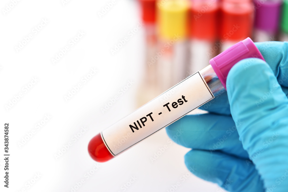 Blood sample tube for NIPT test or non-invasive prenatal testing, diagnosis for fetal Down syndrome in pregnancy woman