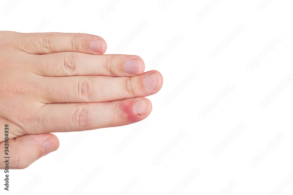 person with finger infection disease. fingernail pain. isolated on white background. copy space person with finger infection disease. fingernail pain. isolated on white background. copy space