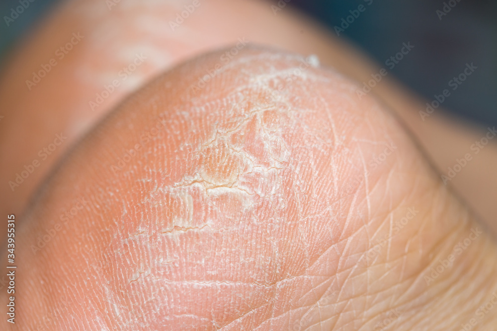 dry dehydrated skin on the heels of female legs dry dehydrated skin on the heels of female legs