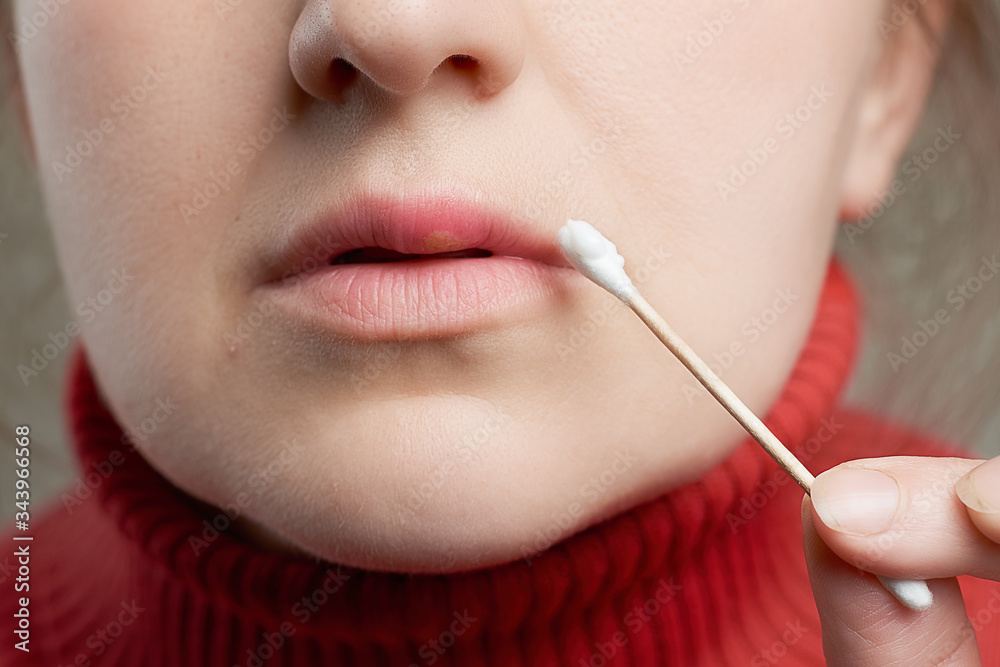 Obraz premium Woman uses cotton swab with ointment to treat herpes on her lip