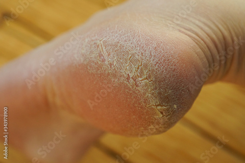 pieds secs 