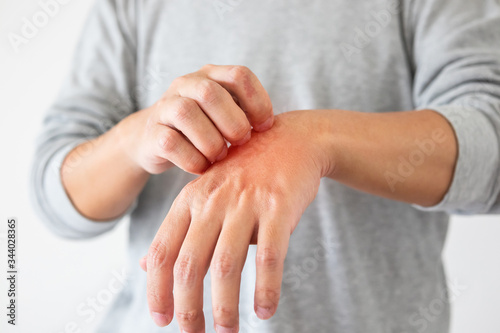 Young asian man itching and scratching on hand from itchy dry skin eczema dermatitis