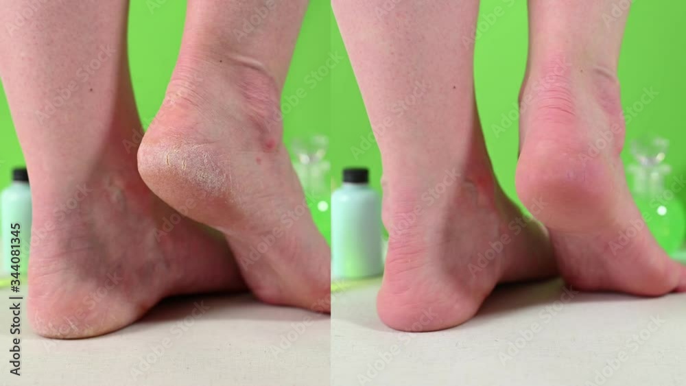 barefoot lady with dry skin problems on heels before and after pedicure procedure against green background of spa salon closeup barefoot lady with dry skin problems on heels before and after pedicure procedure against green background of spa salon closeup