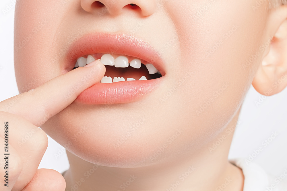 Closeup of the boy touches a crooked milk tooth and experiences pain. Tooth loss, dental problems concept Closeup of the boy touches a crooked milk tooth and experiences pain. Tooth loss, dental problems concept