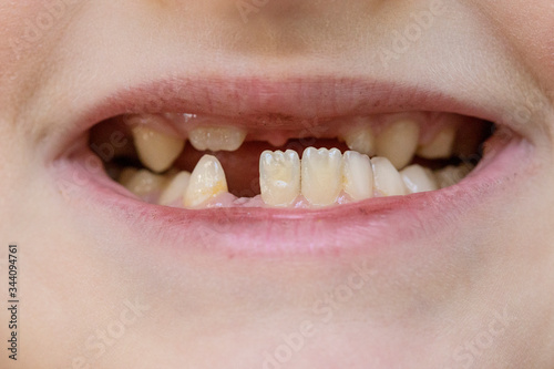 Child's mouth close-up, tooth growth and lack thereof. The concept of baby tooth loss in children