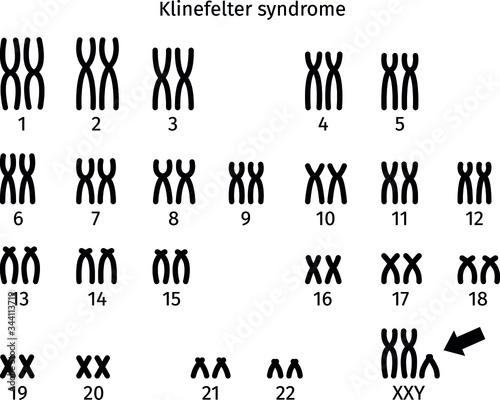 Scheme of Klinefelter syndrome karyotype of human somatic cell 47XXY