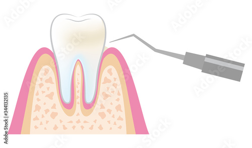 dental_pmtc_step04