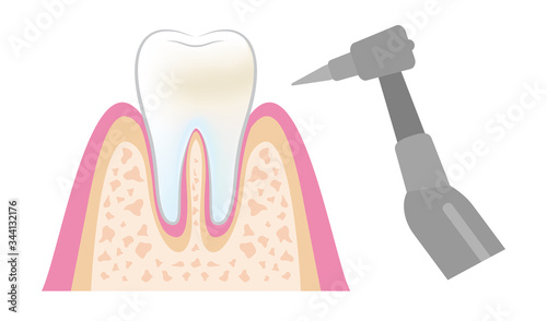 dental_pmtc_step06
