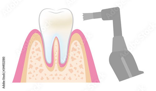 dental_pmtc_step05