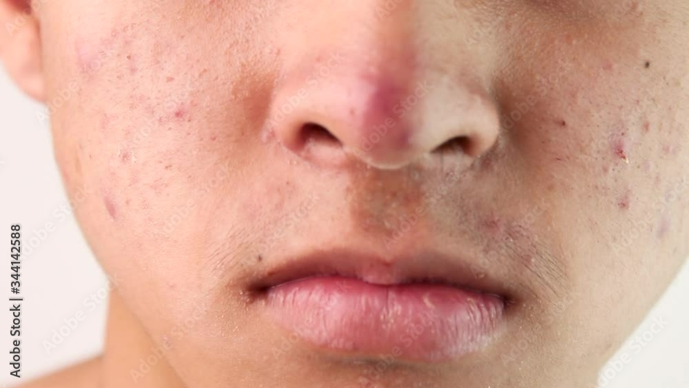 Close up face of Asian teenage guy with acne and problem skin. Skin care concept. Close up face of Asian teenage guy with acne and problem skin. Skin care concept.