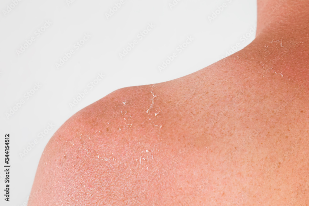 Fototapeta premium Peeled skin on young man shoulder from sun burn. Closeup. Isolated on light gray background. Back view.