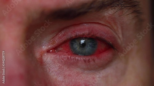 Close up of a severe bloodshot eye. Blepharitis, Conjunctivitis condition