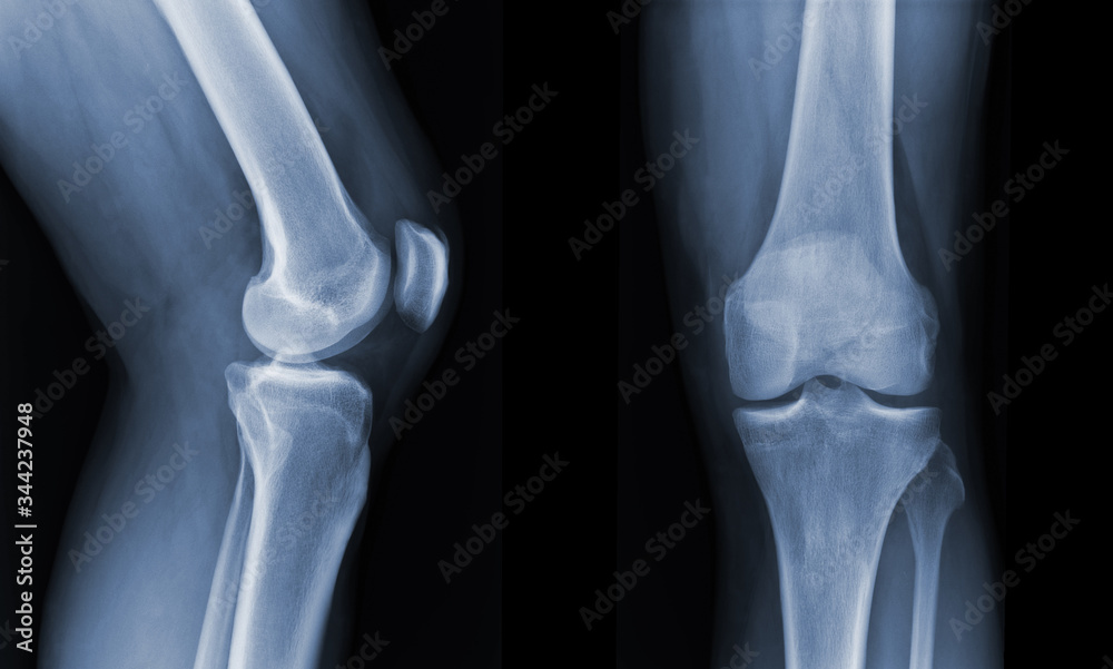 X-ray knee radiograph show state of injury