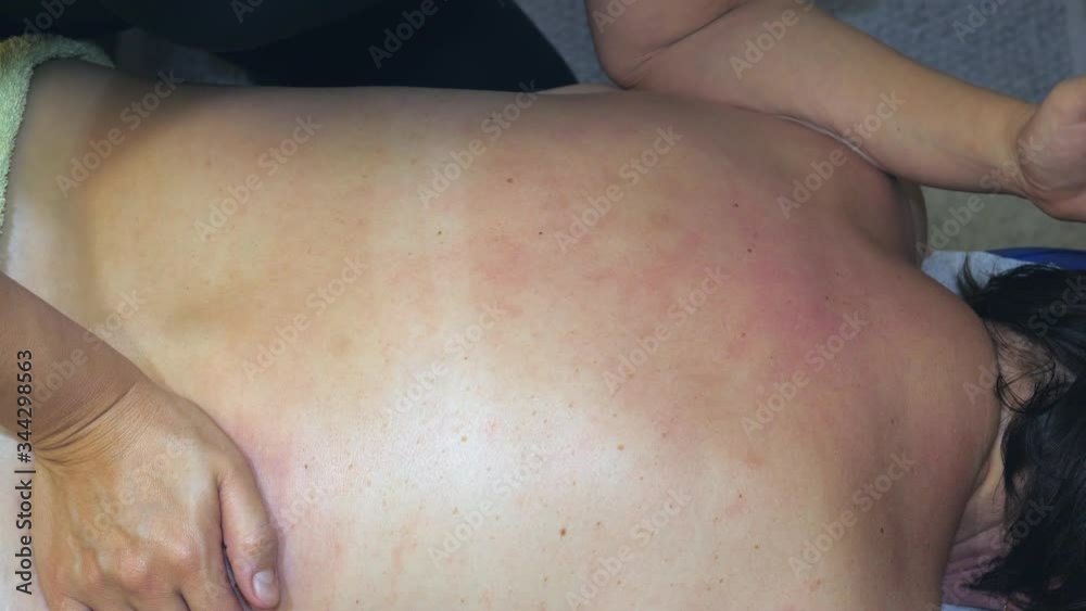 The red spots on the skin on the back of the lady The red spots on the skin on the back of the lady