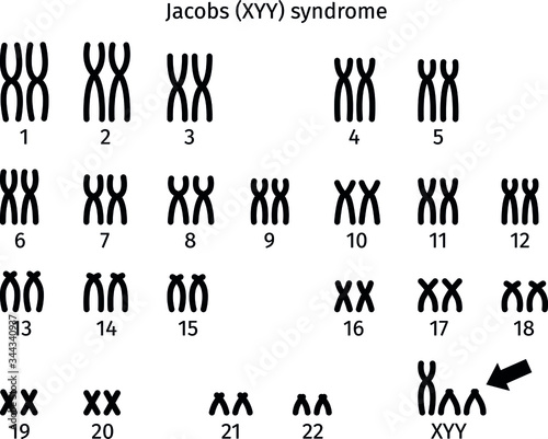Scheme of Jacobs (XYY) syndrome karyotype of human somatic cell 47XYY