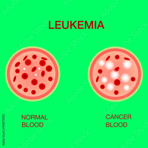 Infographic image of leukemia. Leukaemia disease awareness.Leukemia Blood Cells And Normal Blood Cells White Blood Cells Monocyte . Realistic vector picture .Medical and healthcare concept