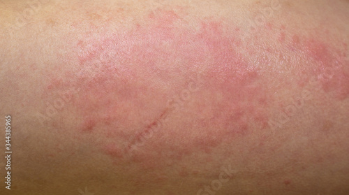 Фотография Skin allergic reaction. Redness of the skin. Allergy