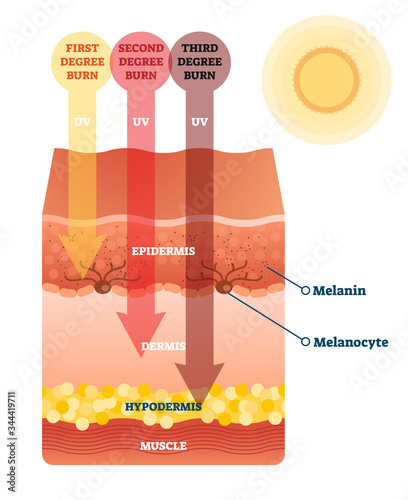 Sunburn skin damage anatomical cross section diagram