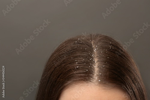 Woman with dandruff in her dark hair on grey background, closeup photo