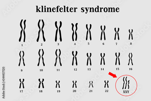 Karyotype of Klinefelter’s or XXY usually in male is born with an extra X chromosome (XXY).