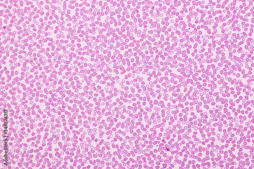 Red blood cells in blood smear, WrightGiemsa stain, analyze by