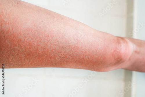 Severe sunburn, summer tan, poor sun protection. Sun allergies, obstruction, itching pain and blisters on the skin of the legs.