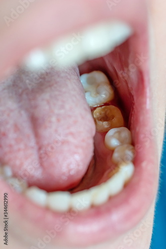 Missing dental crown the second molar inside the mouth of a young Caucasian woman macro close up shoot of the tooth with caries photo