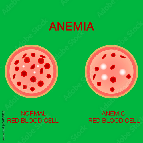 Infographic image of anemia .The difference of Anemia amount of red blood cell and normal. Realistic vector picture of red blood cells or hemoglobin amount in human blood. Medical and healthcare