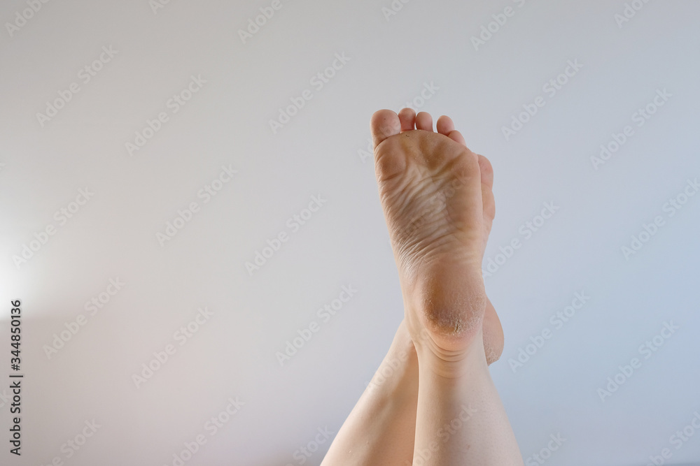 foot with rough skin and a dry heel with many cracks. The concept of